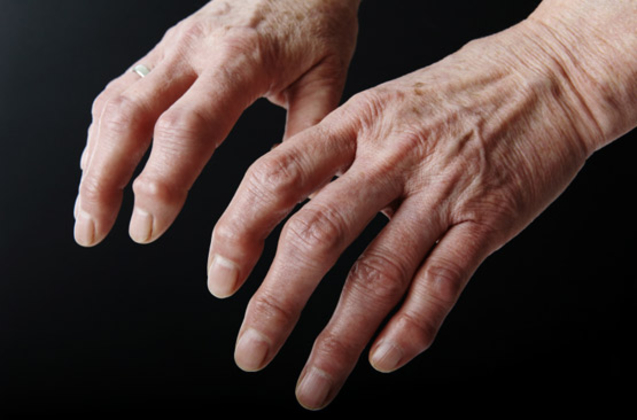 Rééducation de la Main et des Doigts: soulager l'arthrose et les