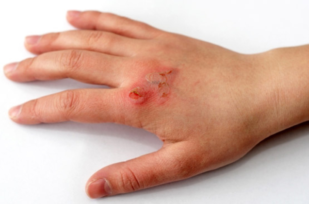 Conseils problèmes de peau : crevasses, blessures, écorchures, brûl